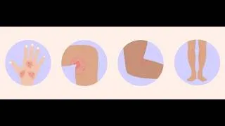 Miniature : Pediatrie - Eruptions Febriles [FMPC]