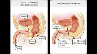 Miniature : Chirurgie Pediatrique - Malformations Ano-Rectales [FMPC]