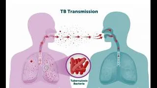 Miniature : Pediatrie - Infections tuberculeuses [FMPC]