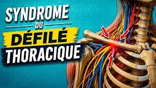 Miniature : Syndrome Du Défilé Thoracique : Symptômes, Causes et Traitements