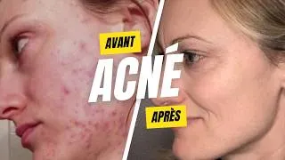 Miniature : LA méthode pour en finir avec l'ACNÉ 👇👇👇