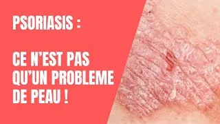 Miniature : PSORIASIS : ce n'est pas qu'un problème de PEAU ! Une cause rarement évoquée