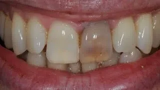 Miniature : KISA K LAKÒZ DAN🦷 MOUN TOUJOU AP CHANJE KOULÈ?