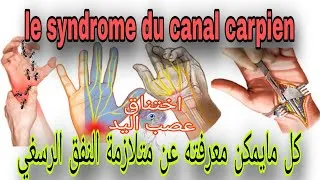 Miniature : كل ما يمكن معرفته عن متلازمة النفق الرسغي/ tout savoir sur le syndrome du canal carpien