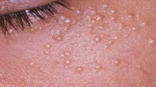 Miniature : Comment enlever les boules de graisse sous les yeux et sur le visage. Remèdes maison