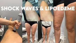 Miniature : Shock waves et lipœdème : mon expérience après plusieurs mois de traitement