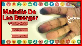Miniature : La thromboangéite oblitérante de Léo Burger