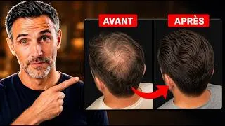 Miniature : Le protocole complet pour récupérer vos cheveux en 6 mois (sans greffe)