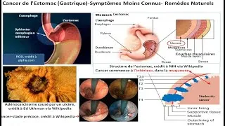 Miniature : Cancer de l'Estomac (Gastrique)- Symptômes Moins Connus  Remèdes Naturels