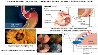 Miniature : Cancerul Gastric (de Stomac)-Simptome Putin Cunoscute-Remedii Naturale