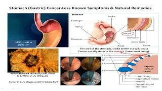 Miniature : Stomach Cancer Less Known Symptoms Natural Remedies