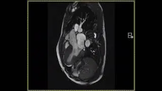 Miniature : Résonnance cardiaque transverse