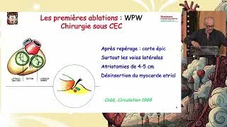 Miniature : "Ablation : de la fulguration à l'électroporation" - Congrès HCV 2026 - l'institut du thorax