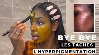 Miniature : MASQUE MAISON CONTRE LES TACHES ET L’HYPERPIGMENTATION: LE MEILLEUR REMÈDE NATUREL !