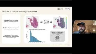 Miniature : Owkin x Servier AI for Glioblastoma Hackaton