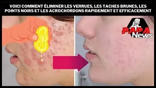 Miniature : Comment éliminer les verrues, les taches brunes, les points noirs et les acrochordons rapidement