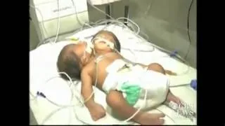 Miniature : Un bébé à deux têtes est né en Inde  Aux âmes sensibles s'abstenir