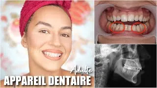 Miniature : Episode 1 : Appareil dentaire adulte chez la meilleure de Paris ? Je vous raconte tout + makeup !