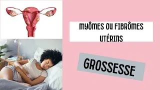Miniature : Comment guérir naturellement des myômes ou fibrômes utérins?