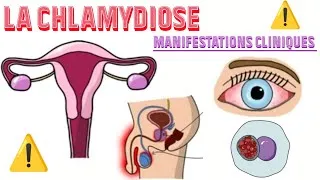 Miniature : Les Symptômes les plus fréquents de la CHLAMYDIOSE 