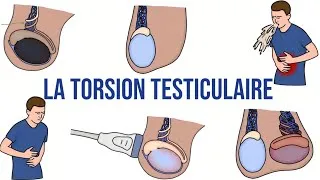 Miniature : LA TORSION TESTICULAIRE : Causes, Symptômes, Diagnostic, Traitement