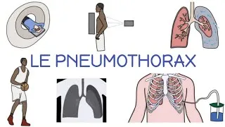 Miniature : Le PNEUMOTHORAX expliqué simplement | Causes, Diagnostic, Traitement