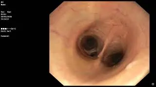 Miniature : Introduction de l’endoscope dans la trachée puis dans les bronches et bronchioles