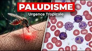 Miniature : Paludisme : Tout Comprendre sur le Plasmodium, les Signes Graves et le Traitement