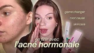 Miniature : ACNÉ HORMONALE : ce qui a VRAIMENT fait la différence (sans roaccutane ni pilule)