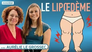 Miniature : Le lipœdème (la maladie des grosses jambes), avec Aurélie Le Grossec