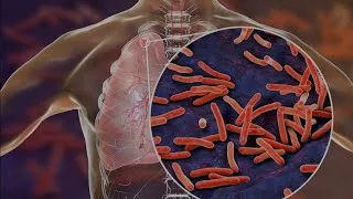 Miniature : Voici ce que personne ne t’a jamais dit au sujet de la TUBERCULOSE et cela va te surprendre.