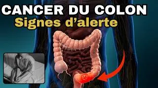 Miniature : N'ignore JAMAIS ces signes d'alerte du CANCER DU COLON