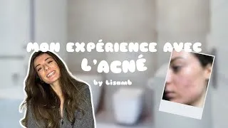 Miniature : MON EXPÉRIENCE AVEC L'ACNÉ : je vous dis tout ! (perte de confiance en moi, cicatrices, pilule ..)
