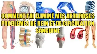 Miniature : COMMENT TRAITER LES ARTHROSES, REIN, SCIATIQUE, ARTÉRIOSCLÉROSE. 🤔 Témoignage, Longrich 👌