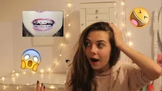 Miniature : ~ Mon parcours Orthodontique ~