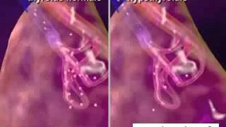 Miniature : La thyroide en 3D pour expliquer l'hyperthyroidie