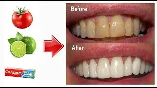 Miniature : Un moyen simple de blanchir les dents à la maison en 2 minutes, tout le monde ne le sait pas