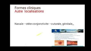 Miniature : 5 min d'infectiologie| les complications de la diphtérie 