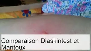 Miniature : Test Diaskin - alternative au test de Mantoux : comparaison et effets secondaires