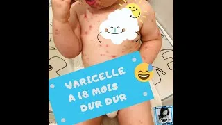 Miniature : Bébé à la Varicelle comment la soigner ? maman1erpas