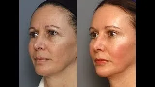 Miniature : Retrouvez une peau ferme et lisse en 5 minutes avec ce masque liftant antirides !