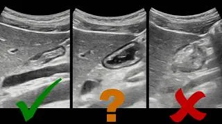 Miniature : L'échographie gastrique en anesthésie