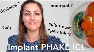 Miniature : Mon opération de la myopie par implants PHAKE !