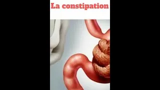 Miniature : ASTUCE NATUREL PUISSANTE POUR SOIGNER LA CONSTIPATION