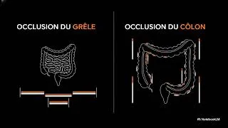 Miniature : 🚨 Occlusions intestinales : Comprendre l'urgence chirurgicale en quelques minutes ! | MED ACADEMY