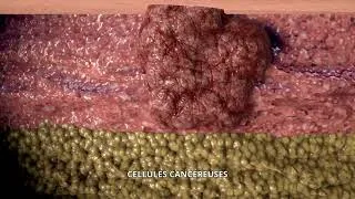 Miniature : cellules normales et cellules cancéreuses