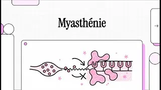 Miniature : La Myasthénie (Myasthenia Gravis) : Physiopathologie, Symptômes et Traitements | Neurologie en vidéo