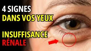 Miniature : Vos yeux révèlent des dommages rénaux des années avant les premiers symptômes