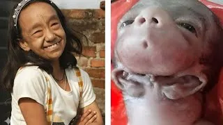 Miniature : 10 enfants rares et incroyables nés avec des visages que vous n'imaginerez jamais!
