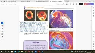 Miniature : EB 9 Biologie Accidents cardio vasculaires
